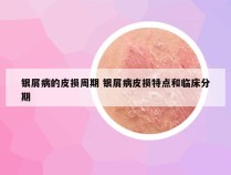 银屑病的皮损周期 银屑病皮损特点和临床分期