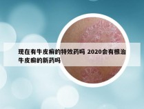 现在有牛皮癣的特效药吗 2020会有根治牛皮癣的新药吗