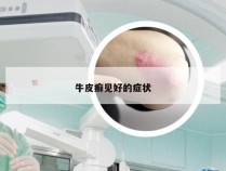 牛皮癣见好的症状