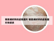 银屑病好转的迹象图片 银屑病好转的迹象图片和症状