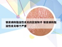 银屑病和脂溢性皮炎的区别知乎 银屑病和脂溢性皮炎哪个严重