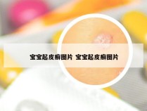 宝宝起皮癣图片 宝宝起皮癣图片