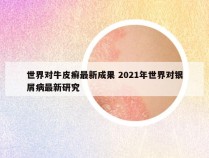 世界对牛皮癣最新成果 2021年世界对银屑病最新研究