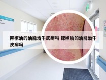 辣椒油的油能治牛皮癣吗 辣椒油的油能治牛皮癣吗