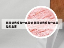 银屑病光疗有什么害处 银屑病光疗有什么害处和危害