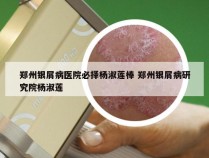 郑州银屑病医院必择杨淑莲棒 郑州银屑病研究院杨淑莲