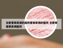 合肥看银屑病的医院看银屑病的医院 合肥银康银屑病医院