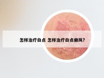 怎样治疗白点 怎样治疗白点癫风?