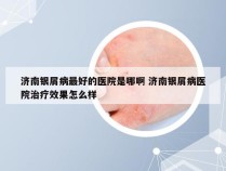 济南银屑病最好的医院是哪啊 济南银屑病医院治疗效果怎么样