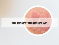 银屑病的研究 银屑病的研究历史