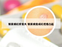 银屑病红疹变大 银屑病变成红疙瘩凸起