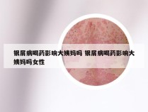 银屑病喝药影响大姨妈吗 银屑病喝药影响大姨妈吗女性