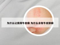 为什么让我得牛皮癣 为什么会有牛皮肤癣