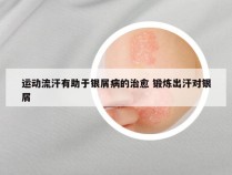 运动流汗有助于银屑病的治愈 锻炼出汗对银屑