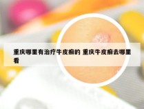 重庆哪里有治疗牛皮癣的 重庆牛皮癣去哪里看