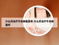 什么药治疗牛皮癣最管用 什么药治疗牛皮癣最好