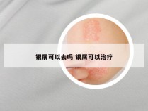 银屑可以去吗 银屑可以治疗