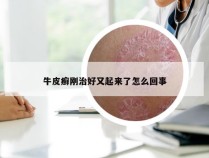 牛皮癣刚治好又起来了怎么回事