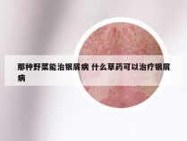 那种野菜能治银屑病 什么草药可以治疗银屑病