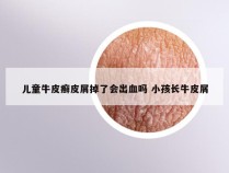 儿童牛皮癣皮屑掉了会出血吗 小孩长牛皮屑