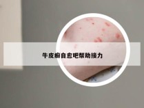 牛皮癣自愈吧帮助接力