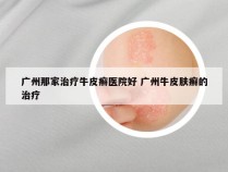 广州那家治疗牛皮癣医院好 广州牛皮肤癣的治疗