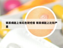 银屑病腿上有红色硬疙瘩 银屑病腿上比较严重