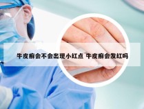 牛皮癣会不会出现小红点 牛皮癣会发红吗