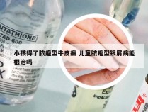 小孩得了脓疱型牛皮癣 儿童脓疱型银屑病能根治吗