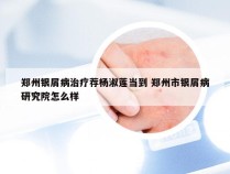 郑州银屑病治疗荐杨淑莲当到 郑州市银屑病研究院怎么样
