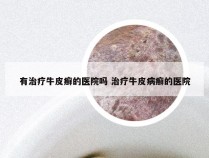 有治疗牛皮癣的医院吗 治疗牛皮病癣的医院