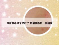 银屑病不红了又红了 银屑病不红一圈起皮