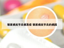 银屑病关节炎病发症 银屑病关节炎的病因