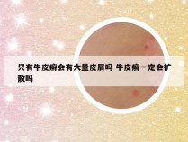只有牛皮癣会有大量皮屑吗 牛皮癣一定会扩散吗