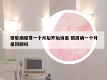 银屑病爆发一个月后开始消退 银屑病一个月是初期吗