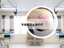 牛皮癣怎么治疗疗