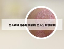 怎么辨别是不是银屑病 怎么分辨银屑病