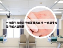 一来康牛皮癣治疗仪效果怎么样 一来康牛皮治疗仪大连销售