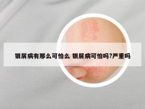 银屑病有那么可怕么 银屑病可怕吗?严重吗