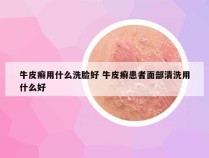 牛皮癣用什么洗脸好 牛皮癣患者面部清洗用什么好