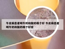 牛皮癣患者喝牛奶和酸奶哪个好 牛皮癣患者喝牛奶和酸奶哪个好些