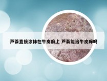 芦荟直接涂抹在牛皮癣上 芦荟能治牛皮痒吗