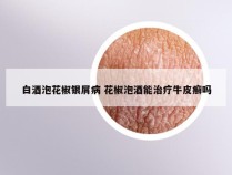 白酒泡花椒银屑病 花椒泡酒能治疗牛皮癣吗