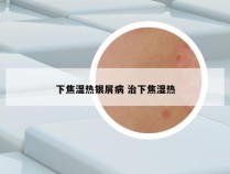 下焦湿热银屑病 治下焦湿热