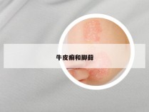 牛皮癣和脚藓