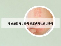 牛皮癣能用甘油吗 银屑病可以擦甘油吗