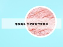 牛皮癣忌 牛皮皮癣饮食禁忌