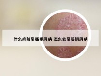 什么病能引起银屑病 怎么会引起银屑病