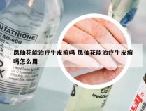 凤仙花能治疗牛皮癣吗 凤仙花能治疗牛皮癣吗怎么用
