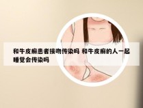 和牛皮癣患者接吻传染吗 和牛皮癣的人一起睡觉会传染吗